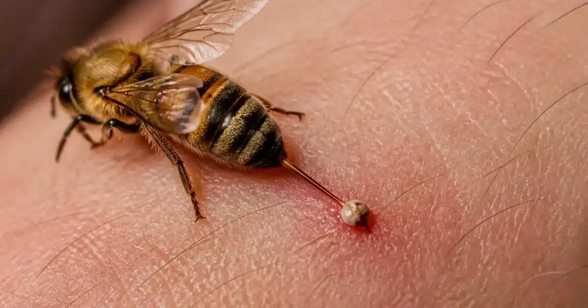Abeille au dard enfonce dans la peau humaine, abdomen detache