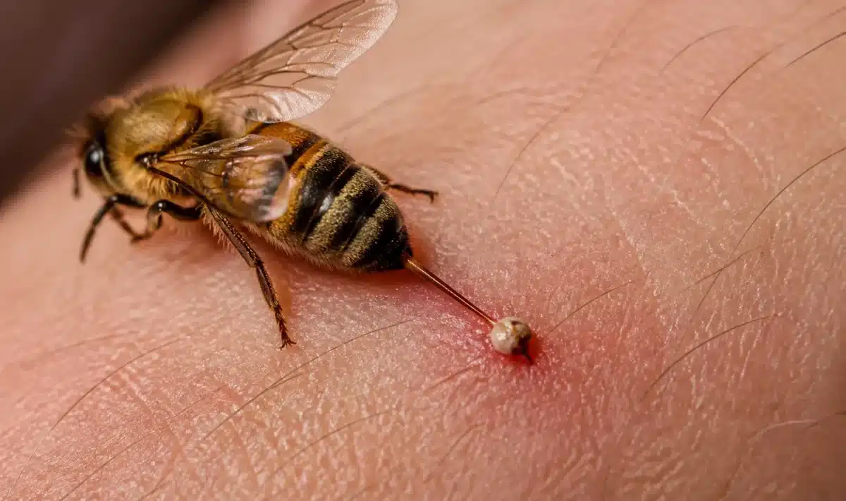 Abeille au dard enfonce dans la peau humaine, abdomen detache